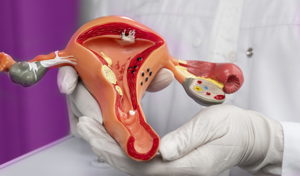 PCOS - Polycystic Ovary Syndrome_ VK21clinic general surgery - Gynecology - Medical Service Puppalguda hyderabad