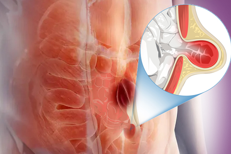 hernia vk21clinic general surgery - Gynecology - Medical Service Puppalguda hyderabad